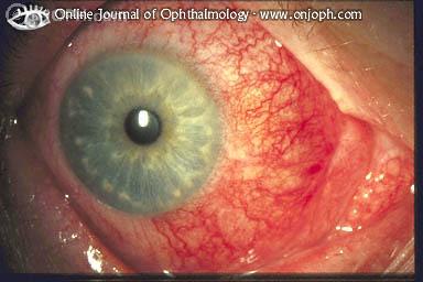 Hyperemiske overfladiske episklerale kar